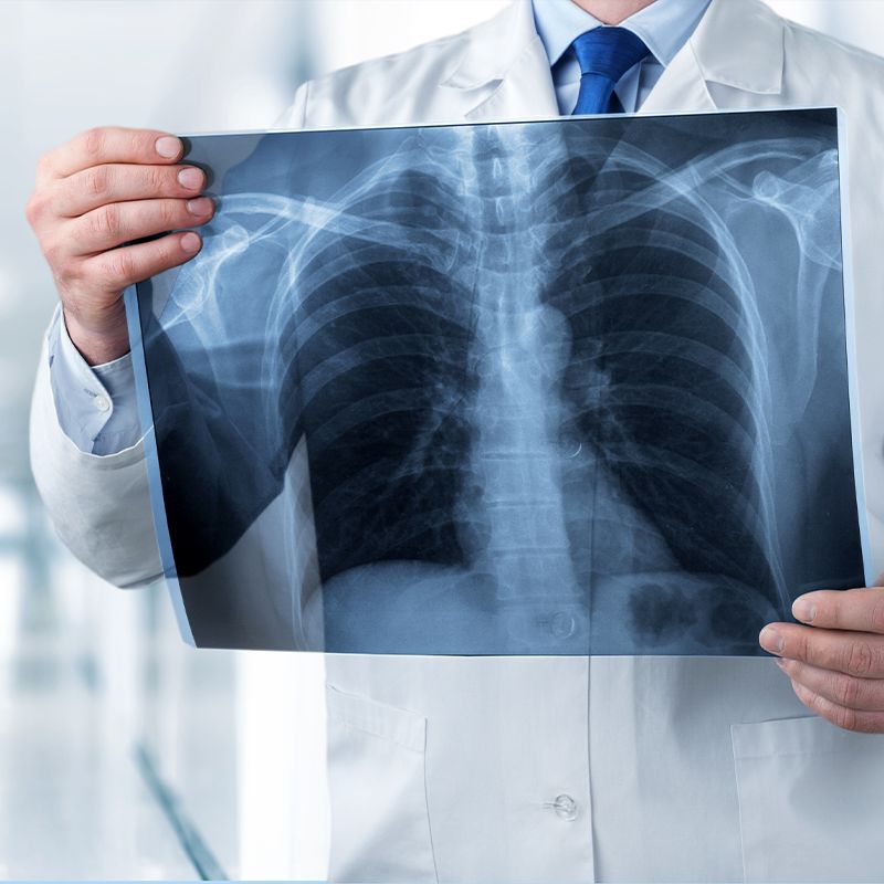 Lungs X-ray